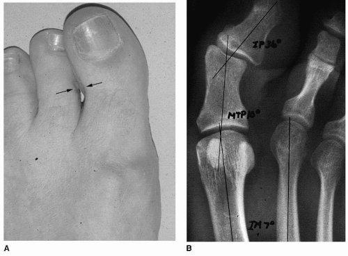 How to fix my two big toe nails that grow sideways? photo 2