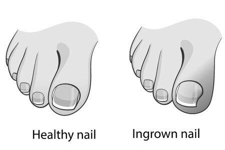 How to fix my two big toe nails that grow sideways? image 1