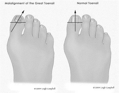 How to fix my two big toe nails that grow sideways? image 3