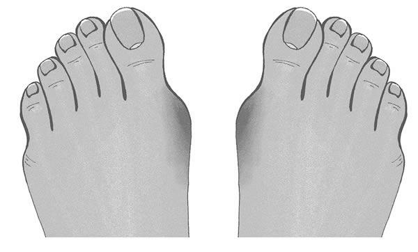 How to fix my two big toe nails that grow sideways? image 8