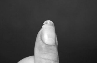 What do split fingernails indicate? image 0