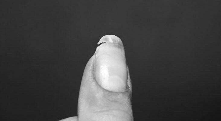 What do split fingernails indicate? image 0