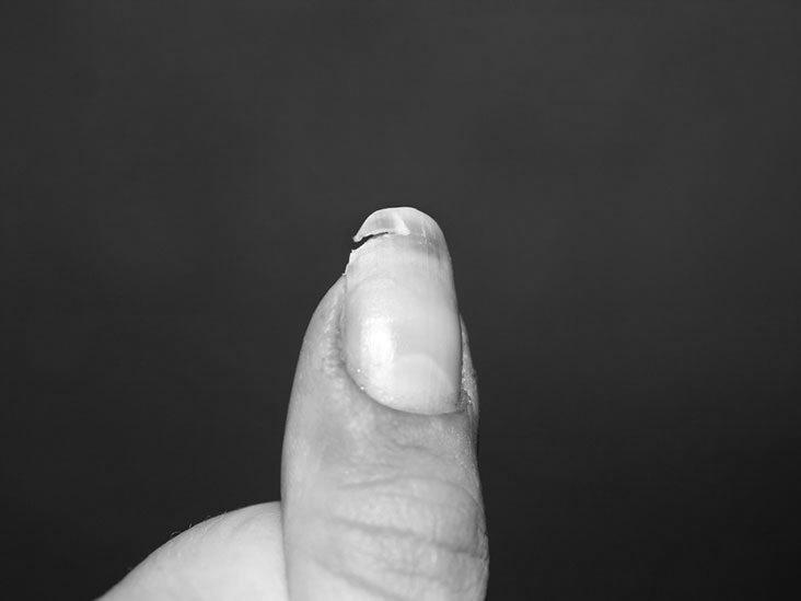 What do split fingernails indicate? image 2