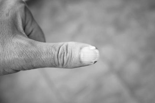 What do split fingernails indicate? image 9