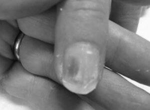 Why do my nails go green under false nails? image 0
