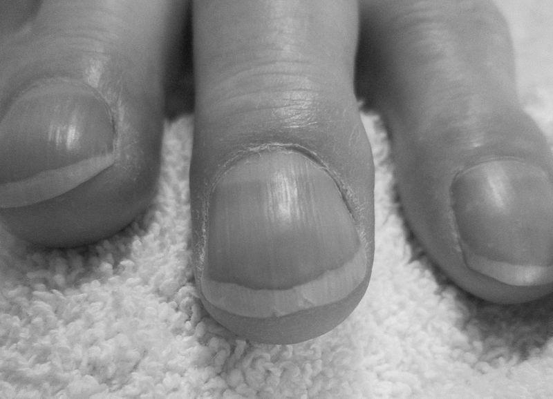 Is nails condition shows tells about our health? photo 1