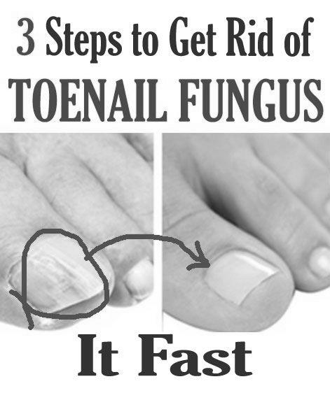 What is the best way to get rid of toenail fungus? photo 3
