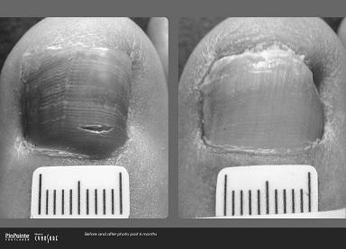 What is the best way to get rid of toenail fungus? photo 5