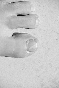 What is the best way to get rid of toenail fungus? photo 6