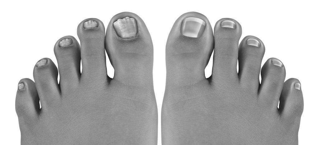 What is the best way to get rid of toenail fungus? photo 10
