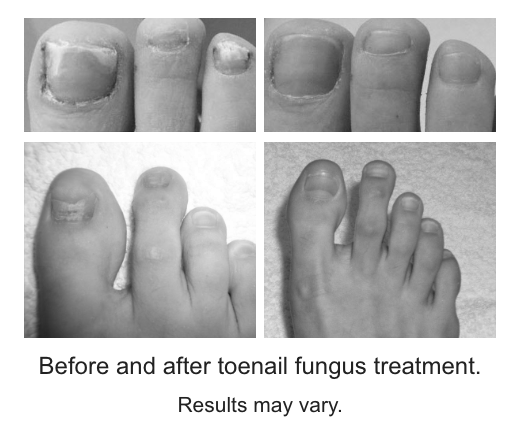 What is the best way to get rid of toenail fungus? photo 11