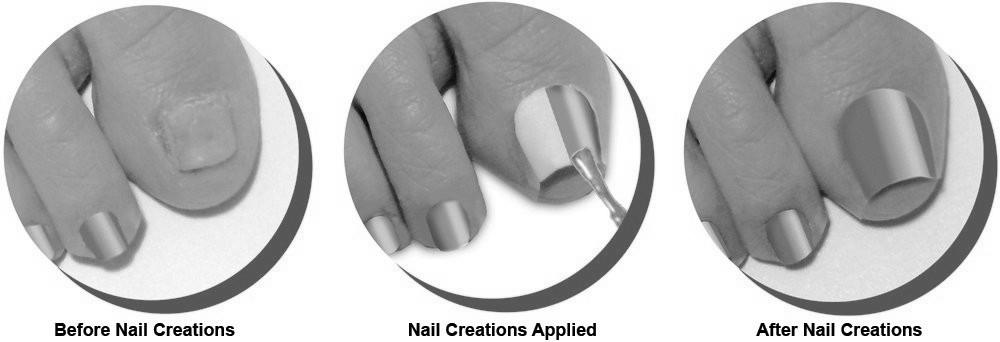 How do I protect my nail bed after losing my nail? image 9
