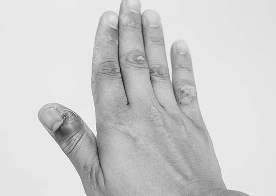 What is nail infection? image 2