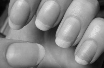 Why are my nails yellow? image 0