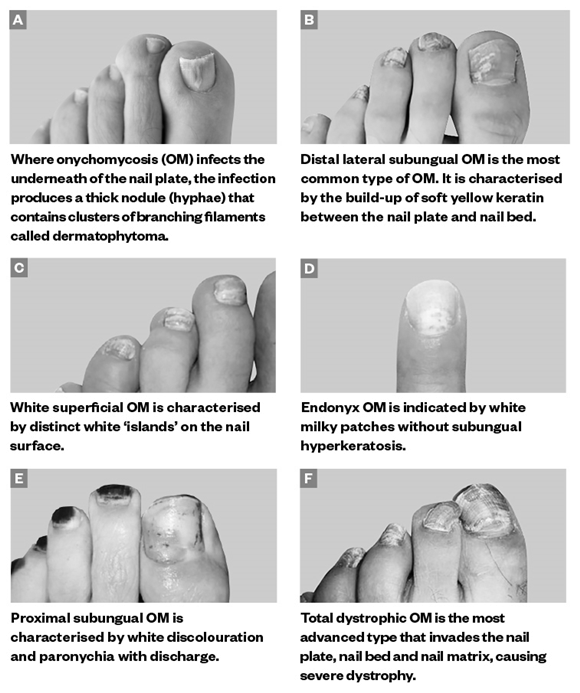 Beginning Stages And Early Signs Of Toenail Fungus? photo 1