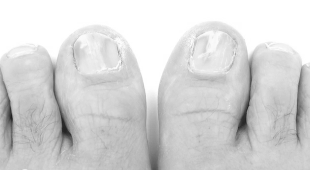 Beginning Stages And Early Signs Of Toenail Fungus? photo 6