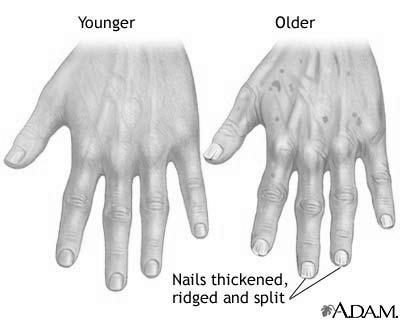 What can cause nails to become thick and ridged? photo 5