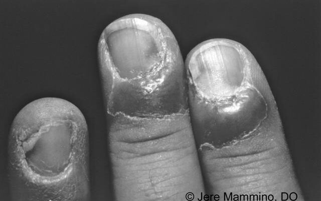 Will a fingernail grow back after acute paronychia? photo 0