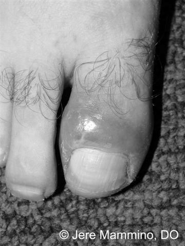 Will a fingernail grow back after acute paronychia? photo 2
