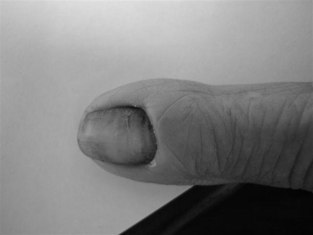 Will a fingernail grow back after acute paronychia? photo 3