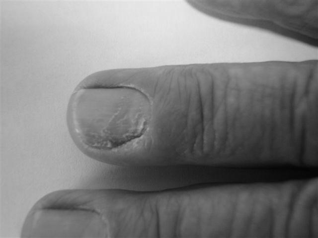 Will a fingernail grow back after acute paronychia? photo 5