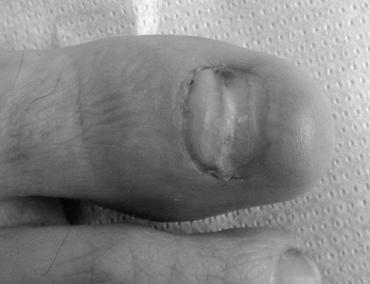 Will a fingernail grow back after acute paronychia? photo 8