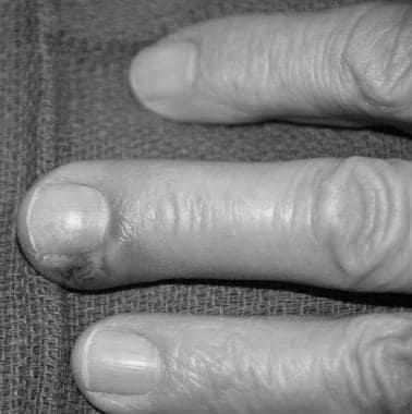 Will a fingernail grow back after acute paronychia? photo 10