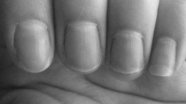 What can fingernails say about your health? image 10