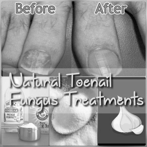 What are the natural treatments for nail fungus ? photo 9