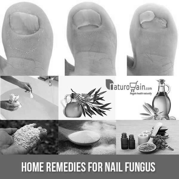 What are the natural treatments for nail fungus ? photo 11