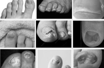 What is the best way to get rid of toenail fungus? image 0