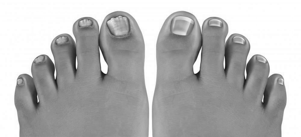 What is the best way to get rid of toenail fungus? image 2