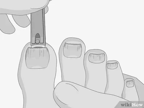 What is the best way to get rid of toenail fungus? image 8
