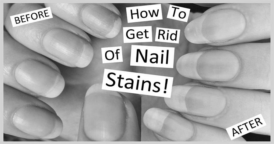 Why do you get yellow nails and how do you get rid of it? image 1