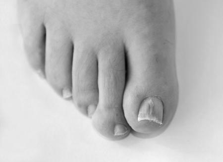 Beginning Stages And Early Signs Of Toenail Fungus? image 0