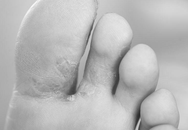 Beginning Stages And Early Signs Of Toenail Fungus? image 3