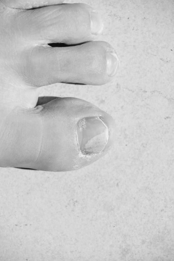 Beginning Stages And Early Signs Of Toenail Fungus? image 6