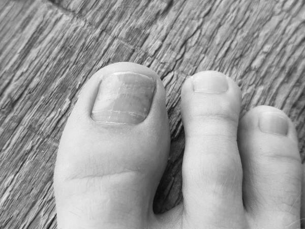 Beginning Stages And Early Signs Of Toenail Fungus? image 7
