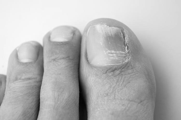 What is nail infection? image 8