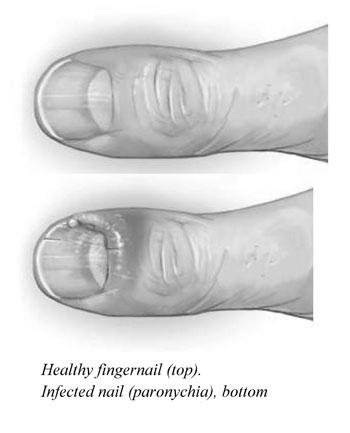 Will a fingernail grow back after acute paronychia? image 1