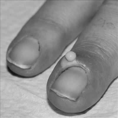 Will a fingernail grow back after acute paronychia? image 6