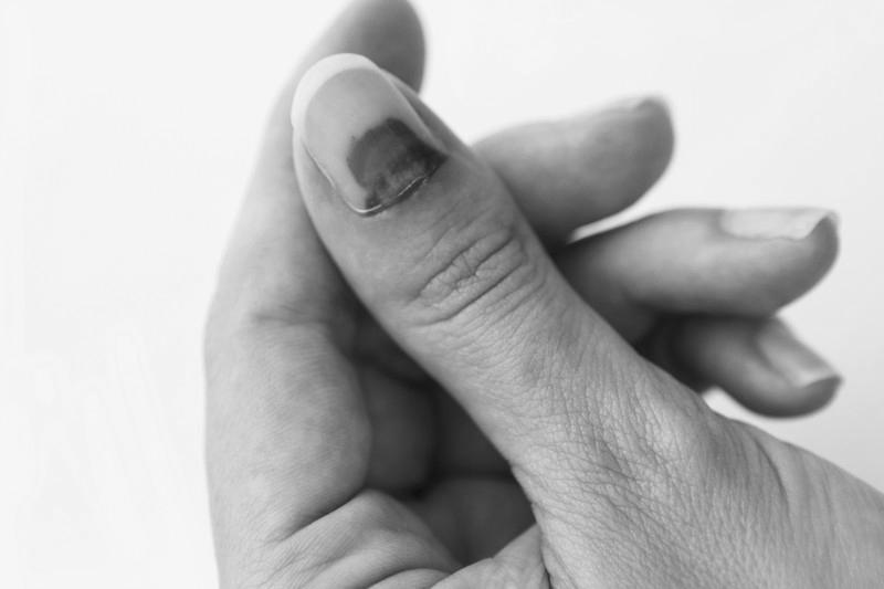 Will a fingernail grow back after acute paronychia? image 8