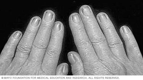 What causes fingernails to turn yellow? photo 3