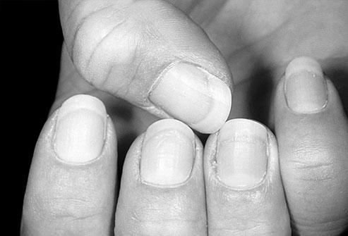 What causes fingernails to turn yellow? photo 7
