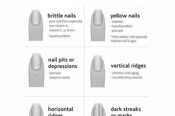 What can fingernails say about your health? image 0