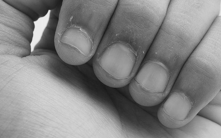 Why does the skin below the nails peel and cause huge pain? image 3