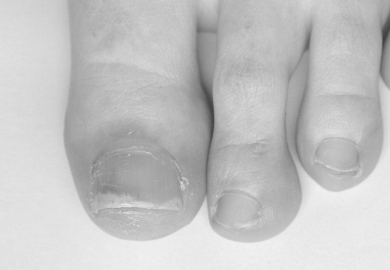 Why does the skin below the nails peel and cause huge pain? image 5