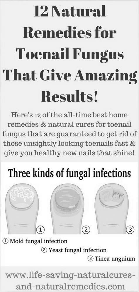 What are the natural treatments for nail fungus ? photo 1