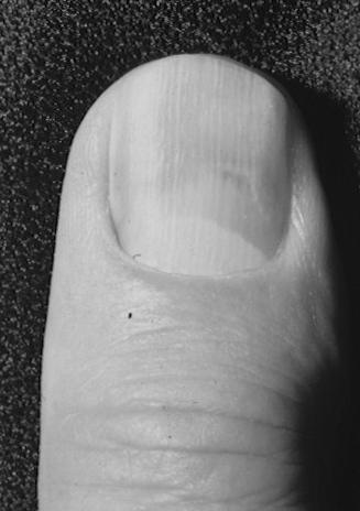 What causes a green nail bed? How can it be treated? image 5
