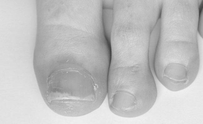 Can diseases really affect our nails? image 0